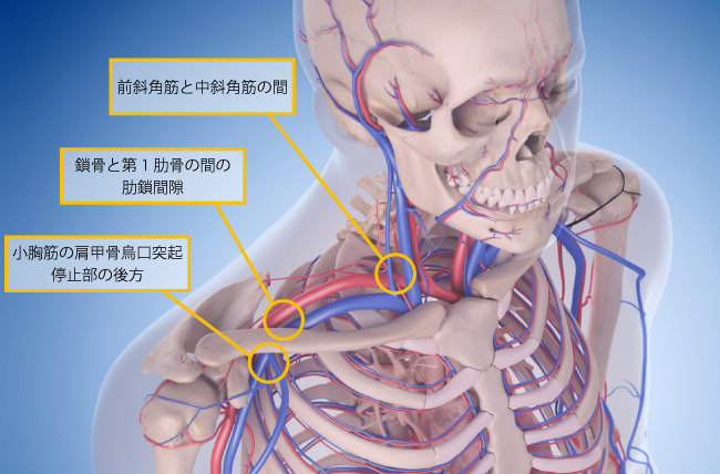胸郭出口症候群、圧迫により発症原因となりうる3カ所