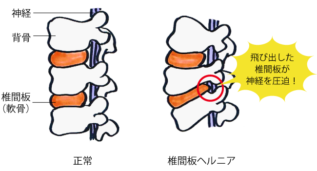 椎間板ヘルニアのイメージ