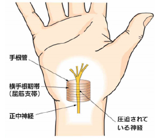 手根管症候群（引用：日本手外科学会、代表的な手外科疾患 1.手根管症候群、2017年、P.3）